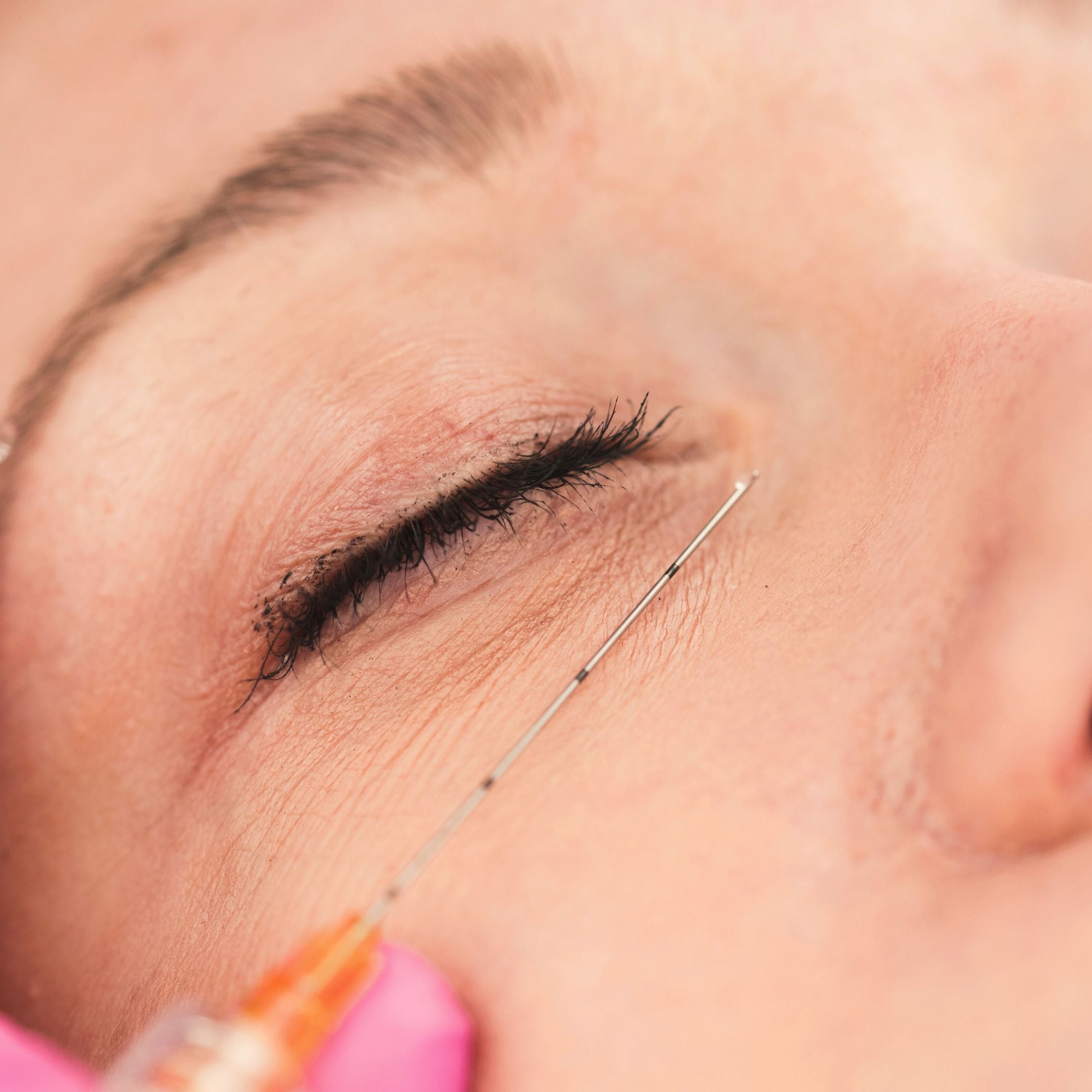 FeelSoft®  Micro Filler Cannulas